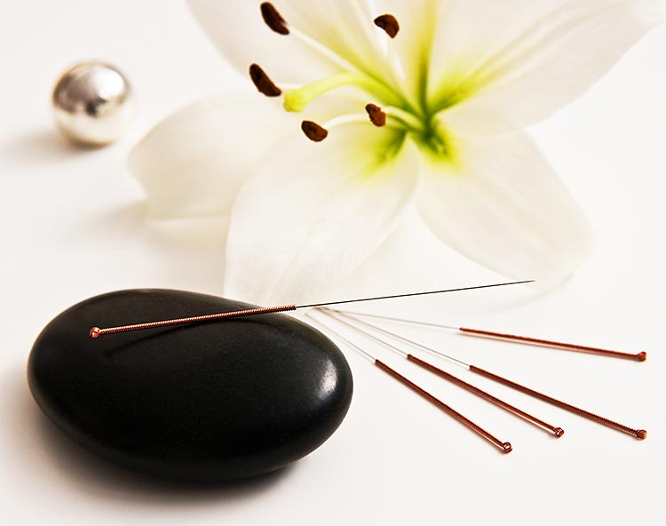 Akupunktur – eine Traditionelle Chinesische Medizin (TCM)